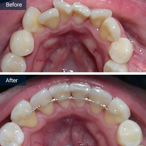 Orthodontics Before After Results