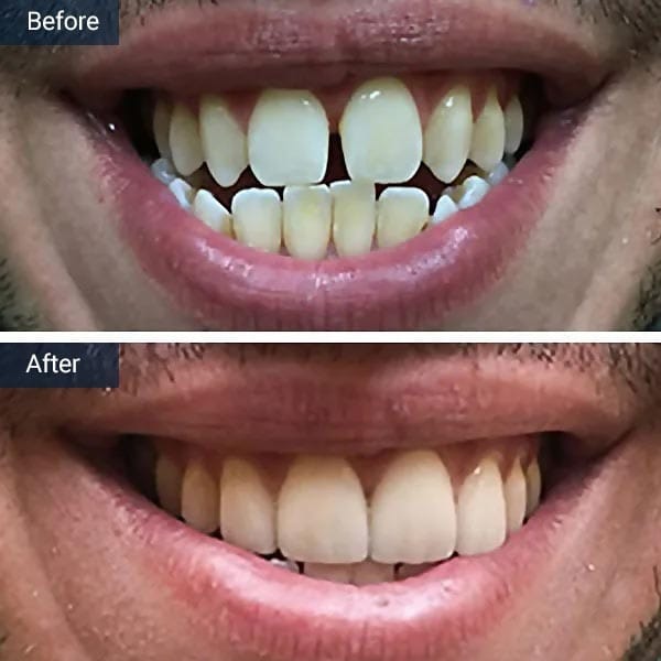 Porcelain Veneers Before After Results