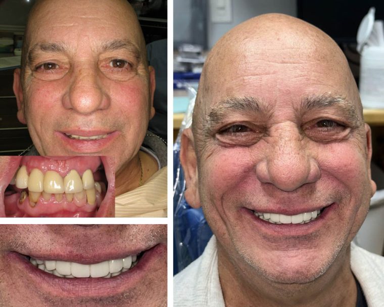 All-on-4 Implants Before and After Results | Case 24