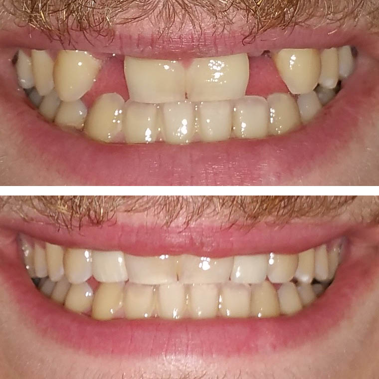 Front Tooth Implants Before and After Pictures (Case 2)