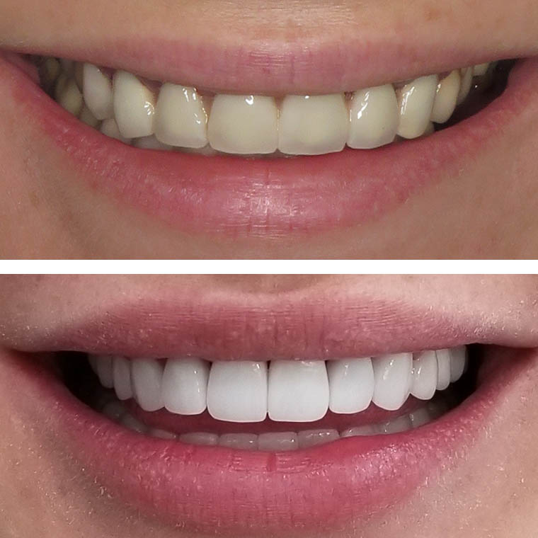 Porcelain Veneer Before and After Pictures (Case 1)