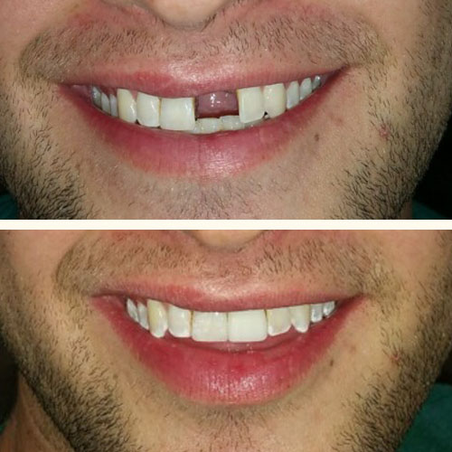 Single Tooth Implants Before and After Pictures (Case 1)