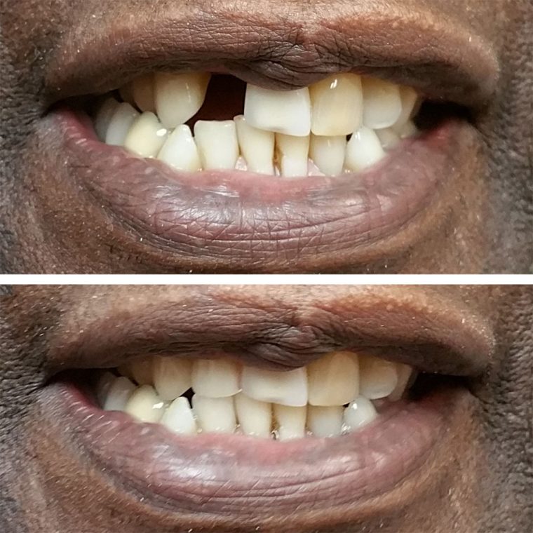 Single Tooth Implants Before and After Pictures (Case 4)