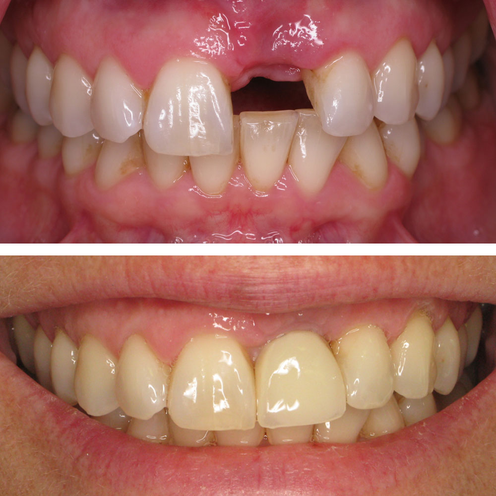 Single Tooth Implants Before and After Pictures (Case 4)