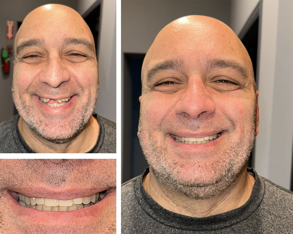 Single Tooth Implants Before and After Pictures (Case 5)