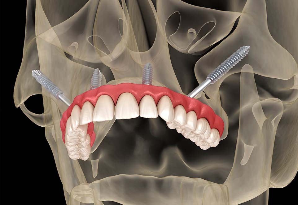Pterygoid dental implant anchored behind the posterior upper jaw near the maxillary sinus